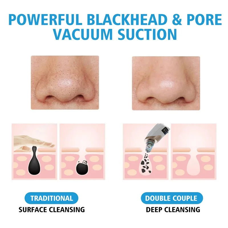 Xiaomi Blackhead Remover Vacuum Suction USB Rechargeable Facial Pore Cleaner Comedone Spot Acne Pimple Black Head Extractor Care